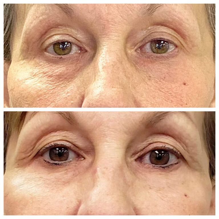 Before skin renewal service and after a session of skin renewal.